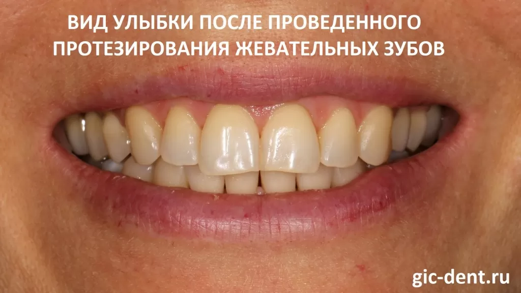 Результат протезирования жевательной группы зубов. После лечения. Доктора - Аветисян Роберт и Дахкильгов Магомед. 